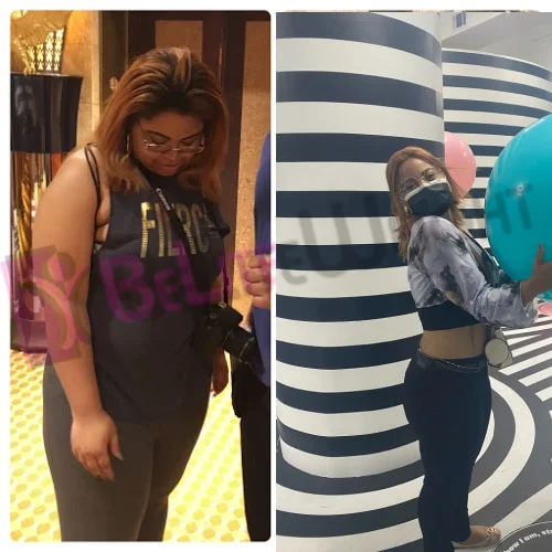 Gastric Sleeve before and after